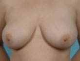 Patient # 62433 Before Photo # 1